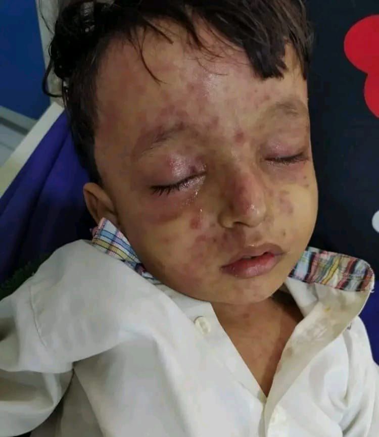 جماعة الحوثي تقر بوفاة 10 أطفال نتيجة انتشار الحصبة