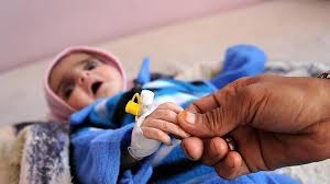 أكثر من 7ملايين يمني بحاجة لعلاج سوء التغذية