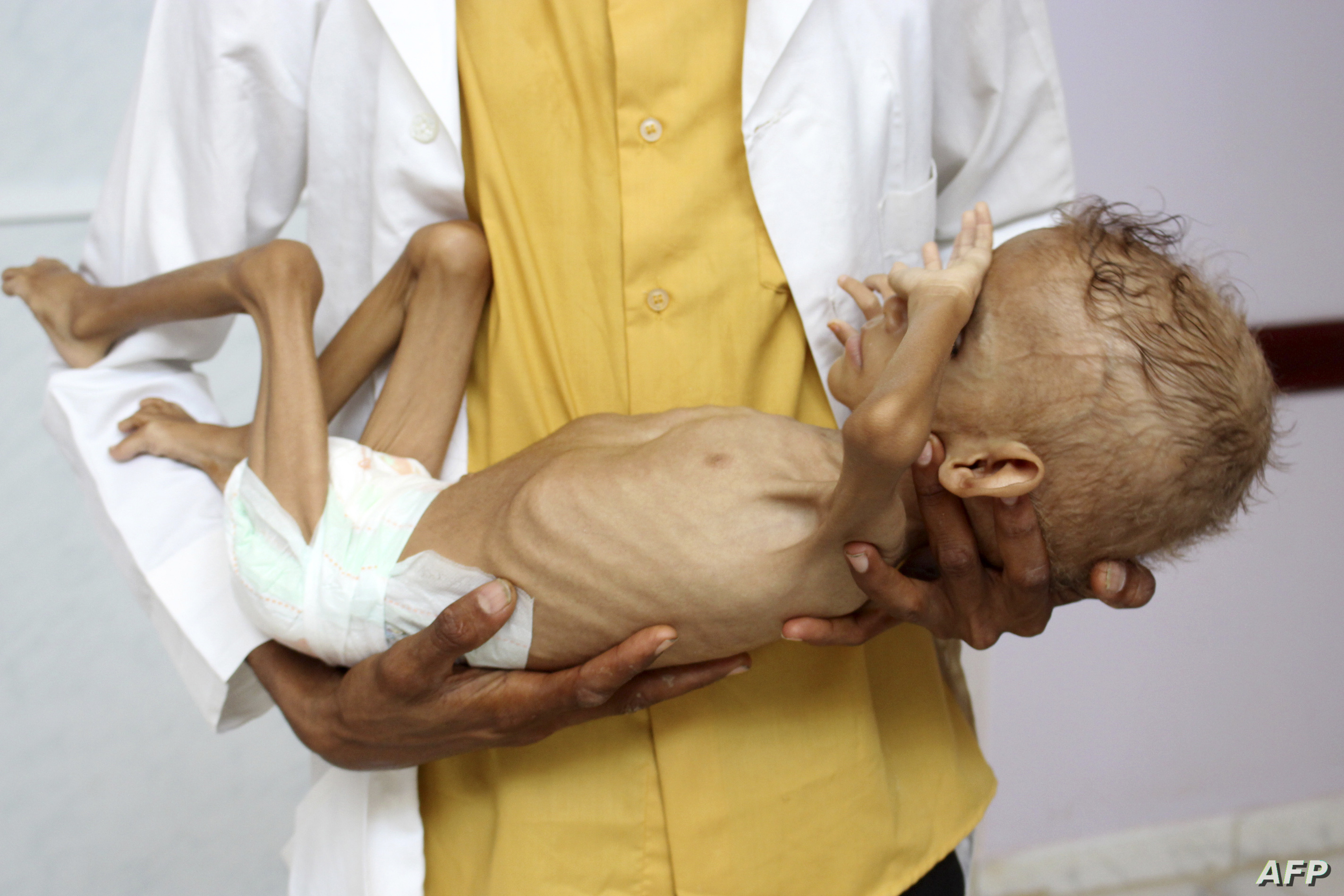 الأمم المتحدة تحذر من إصابة ربع مليون يمني بالكوليرا بحلول سبتمبر المقبل