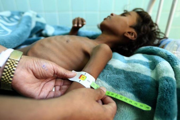 46 بالمائة من أطفال اليمن دون الخامسة يعانون التقزم